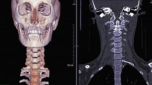 Ct Scan Cervical Spine C-spine 3d Stock Footage Video (100% Royalty-free) 1021089349 | Shutterstock