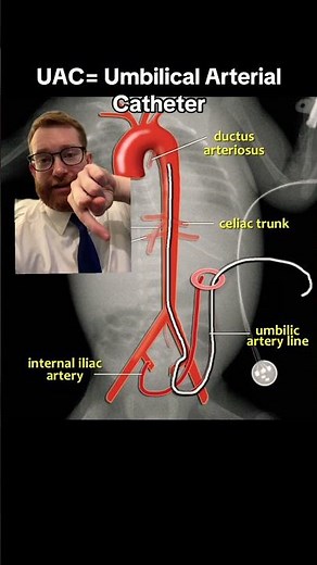 Learn About NICU Procedures Part 1- Umbilical Arterial Catheter