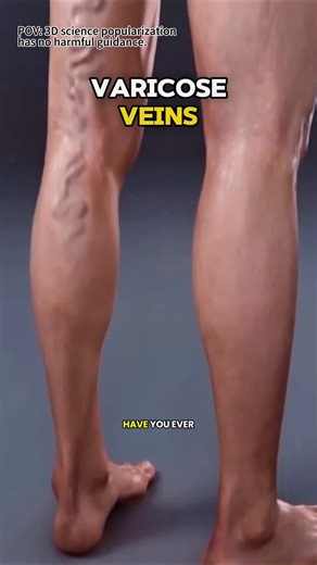 Understanding How Varicose Veins Form: 3D Animation