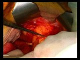 Open Right Hemicolectomy – Technical Principles - Operation No 2 - Part 1 • Video • MEDtube.net