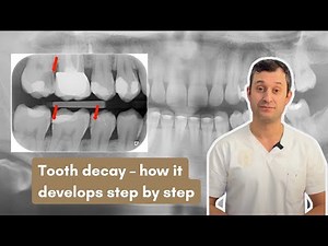 Tooth Decay Explained