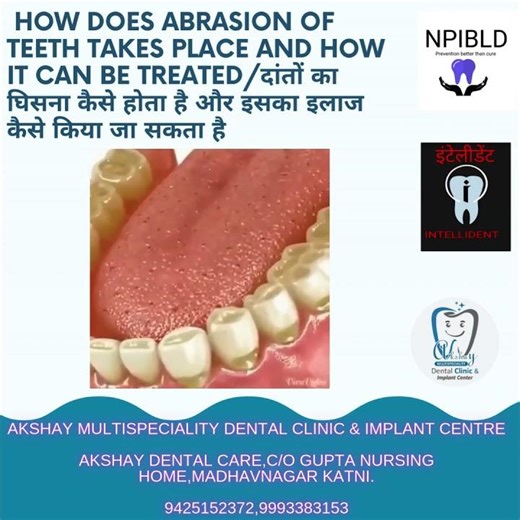 "How Teeth Wear Down: The Science of Abrasion and Attrition"