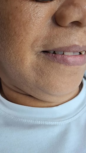Instalación de Protesis Flexible 2 unidades #anaco #odontologia #prostodoncia #protesisdental