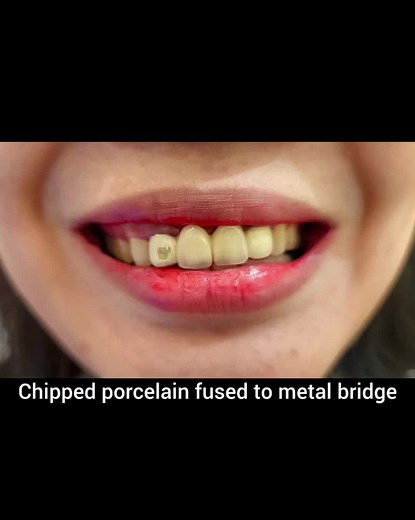 Cosmetic Dental Procedures: Zirconia Restorations and Smile Corrections