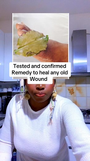 17K views · 329 reactions | Heal your wound with this remedy so effective #highlight #care #caregiver #vira #tips #videovita #fb #fyp #fblifestyle #fbviral #healing #education #awareness | Queeneth Kalu | Facebook