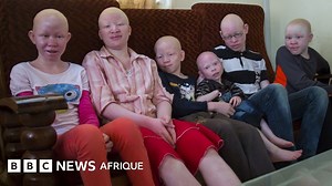 Les albinos victimes de crimes rituels en Afrique australe - BBC News Afrique