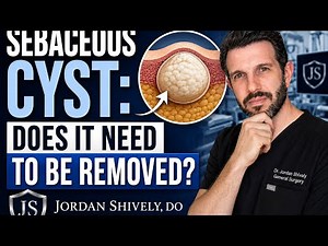 Sebaceous cyst: Does it need to be Removed?