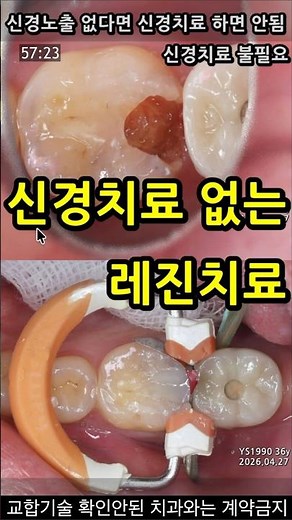 Resin treatment without root canal. Root canal is overtreatment when there is no nerve exposure. ...