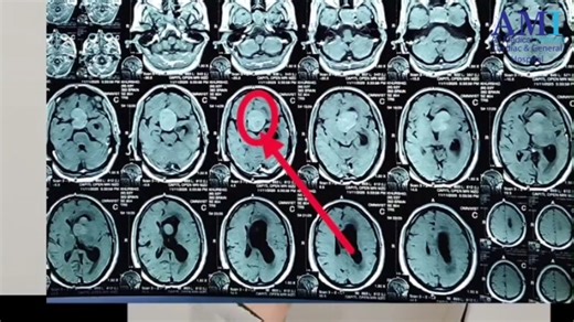 AMI (Cardiac & General Hospital) on Instagram: "Dr. Shahid Sajjad Dar, Consultant Neurosurgeon at AMI Cardiac & General Hospital, is briefing about his patient following a successfully performed craniotomy procedure. The patient is also sharing positive feedback, expressing satisfaction with the treatment, care, and professional approach of the medical team. This successful procedure highlights the expertise of Dr. Shahid Sajjad Dar and reflects AMI’s commitment to providing advanced neurosurgic