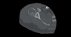 CT scan of shoulder joint axial view showing fracture head of humerus .