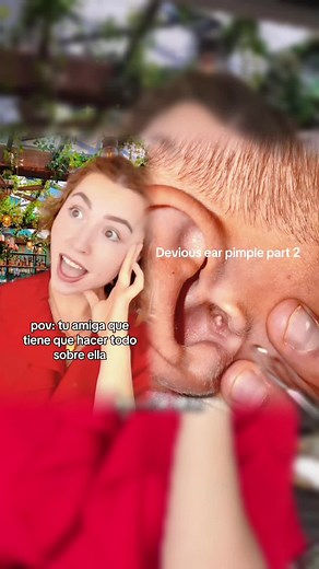 Watch relax and clear your mind a bit #pimplepopperaddict #pimple #extractions #ingrownhairremoval #ingrown #ingrownhair #picking #tweezers #skinpicking #satisfying #blemishes #blemishbandits #cloggedpores #pores #acne #hair #cleanskincare #skincareroutine #fyp #relaxingvideos #viral #trending #viraltiktok #creatorsearchinsights#foryou#tiktok#pvo#skit