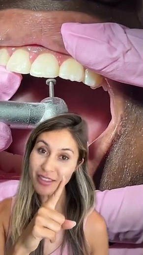 Shaping and Smoothing Teeth After Braces