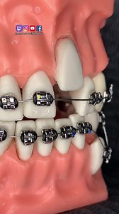 Dr. Diler Cruz #CEDC #dentist #dentistry #dentistryworld #medicine #reelsvideo #reelkarofeelkaro #reels2023 #reelitfeelit #reelschallenge #reelsfacebook #reelsviralシ #reelsusa #fypシ゚ #fypシ゚viralシ | Dr. Diler Cruz