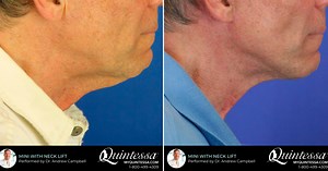 Mini Facelift in Milwaukee, WI | Quintessa