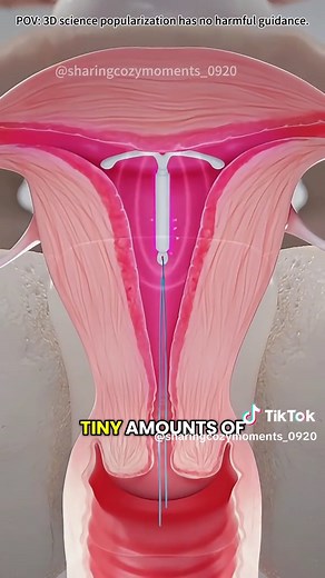 How IUDs Work? | Intrauterine Device (3D Animation) #intrauterinedevice #intrauterinedevices #iud #iudinsertion #copperiud #hormonaliud #iudinsertion #birthcontrol #birthcontroloptions #medical3danimation #3dmedicalanimation