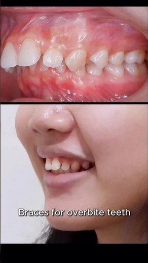 Braces fix overbite teeth and fix your smile :) #braces #orthodontist #dentist #smile #overbite