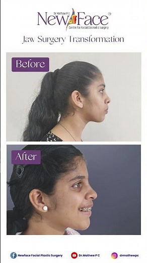 Before & After Jaw Surgery | Facial Harmony Restored – Dr. Mathew PC