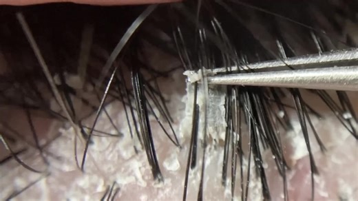 No.180 - peel off scalp scabs - 頭皮のかさぶたもぎ- quitar las costras del cuero cabelludo- 剝去頭皮痂- 두피 딱지 떼어내기 - Dandruff Scratching#dandruffscratching #dandruffremovel #dandrufftreatment #dandruffsolution #peelingskin #peel