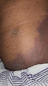 Grey Turner's sign is a rare, bluish bruising on the flanks that signals severe internal bleeding, usually behind the abdominal lining (retroperitoneal hemorrhage), classically from acute pancreatitis but also from ruptured aortic aneurysms, ectopic pregnancies, or trauma. | Doctor's Library, Rajshahi