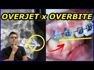 OVERJET x OVERBITE | QUAL A DIFERENÇA? | COMO O DENTISTA CORRIGE COM APARELHO?