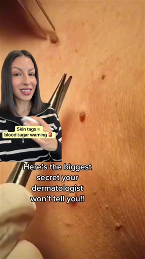 #skintags #prediabetes #type2diabetes | skin tags