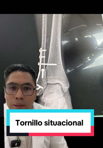 Manejo de Fractura de Tobillo: Tornillos y Situaciones