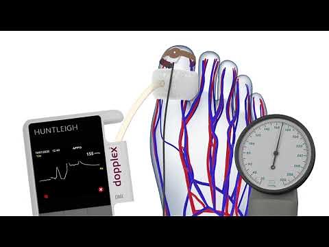 How to Measure the Toe Pressure Index (TBI)