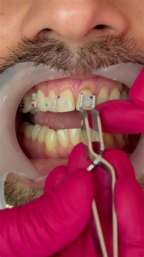 Montare aparat dentar Damon Clear #duet #drmeroiu #invatapetiktok #invatampetiktok #brandstage #dentist #dental