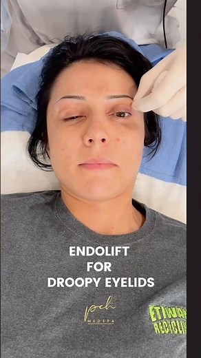 I Tried a Non-Surgical Eye Lift