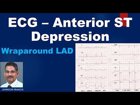 ECG – Anterior ST Depression (Includes a discussion on wraparound LAD)