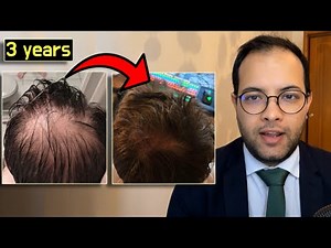 Finasteride before and after hair loss results ( the secret behind it )