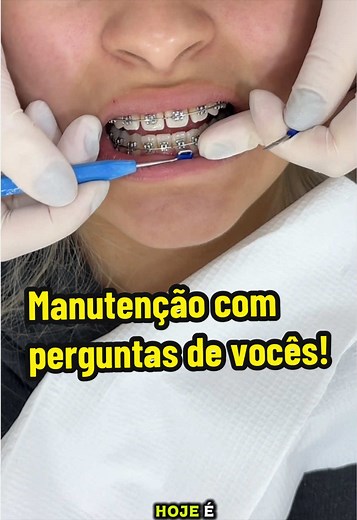 Manutenção de aparelho ortodôntico: perguntas e respostas