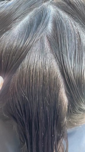 Identifying Lice: What You Need to Know