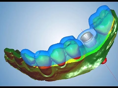 Implant Guide Designing in Planmeca Romexis