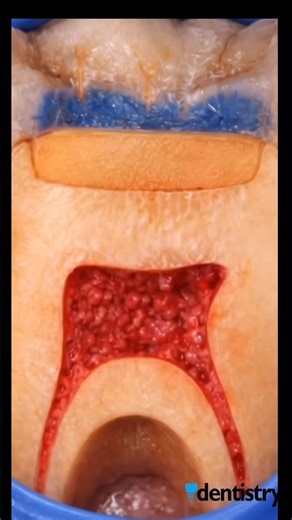 Rawan abdelkader on Instagram: "Direct Pulp Capping - Step by Step Direct pulp capping is a vital pulp therapy technique used to preserve pulp vitality after a small, controlled exposure. 1-Strict isolation is essential to ensure a sterile working field Once exposure occurs, further pulp manipulation must be avoided 2-Gentle irrigation and careful hemorrhage control are mandatory 3-A biocompatible pulp capping material is placed with minimal pressure 4-The goal is to promote dentinal bridge form