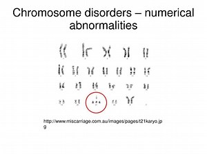 Chromosome disorders – numerical abnormalities - SlideServe