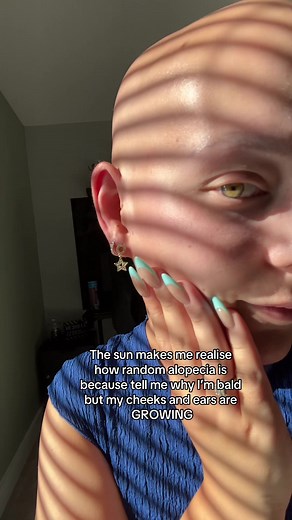 Understanding Alopecia: Random Effects of Hair Loss