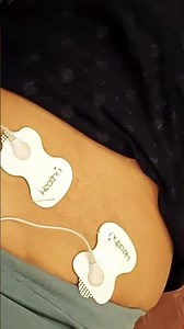 ‪@skillphysioacademy‬ ‪@physionews4319‬ #dryneedling #needling #needlework #physiotherapist#cure