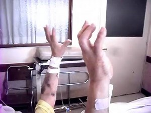 7.6K views · 131 reactions | Asterixis o flapping tremor El...