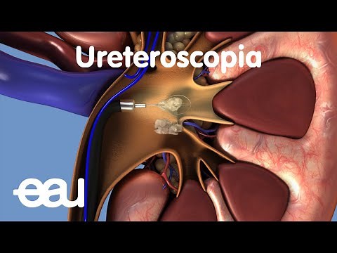 Tratamiento de cálculos renales y ureterales: URS