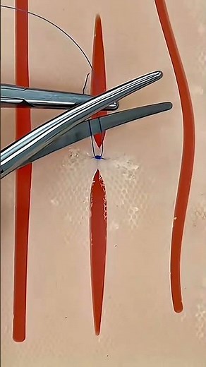 Zip-Stitches: The Smart Way to Close Wounds! 😬 #MedicalFacts #SurgeryTips