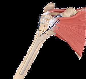 FxBridge™ Tuberosity Repair System