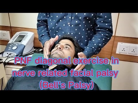 PNF diagonal exercises in nerve related facial palsy (Bell's Palsy)