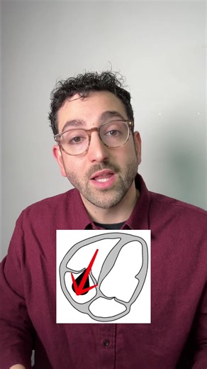 Understanding Tricuspid Regurgitation in Echocardiography