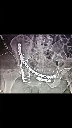 Fixation of acetabulum, Pubic Symphysis and Distal Femur #orthopedics #hipjoint #doctor #anatomy