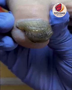 Best Nail Practices for Overgrown Toenails For Better Hygiene #SafeNailCare #HomeNailCare #ThickToenailCare #ToenailSupport | Tots Mags Wheel