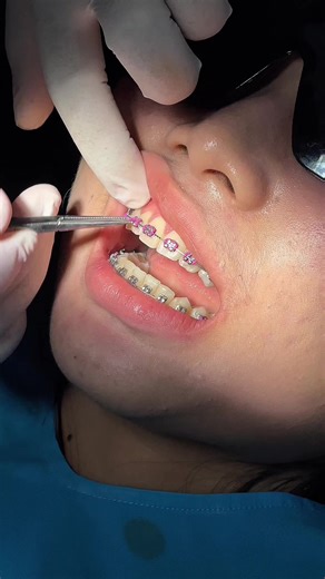 Embrace Pink for a Brighter Smile