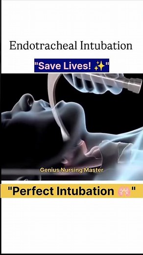 Endotracheal intubation procedure, How to perform intubation, Intubation steps for nursing students
