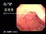 Erosive Duodenitis • Video • MEDtube.net