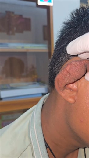 23K views · 103 reactions | Perichondritis | Dr Khaled's Tumour Helpline | Facebook